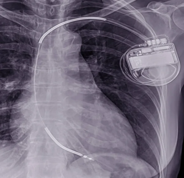 Close Chest Ray Showing Pacemaker — Stock Photo, Image