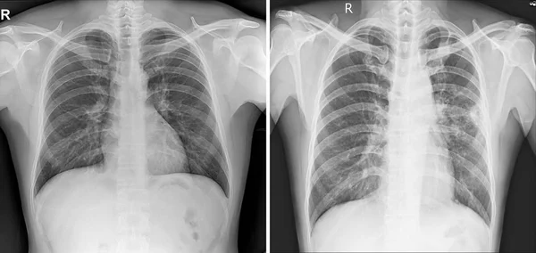 Röntgen Der Brust Ansichten Die Normale Und Abnorme Brust Zeigen — Stockfoto