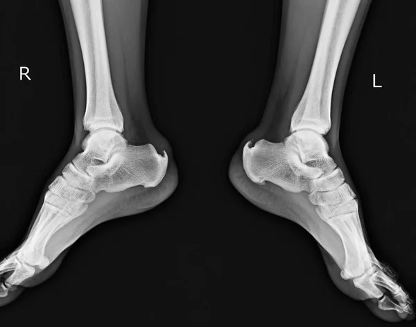 Ακτινογραφία Και Πόδι Showing Πτέρνας Κέντρισμα Δύο Πλευρά — Φωτογραφία Αρχείου