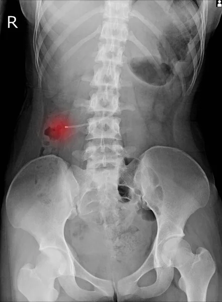 abdomen pain x-ray showing Ventriculoperitoneal (VP) Shunt in abdomen.
