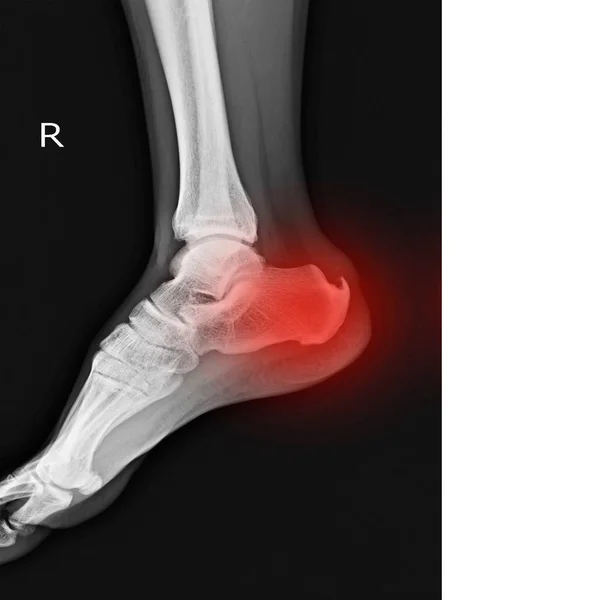 Рентген Правої Ноги Показує Яткову Шпору Червоному Кольорі Простором Копіювання — стокове фото