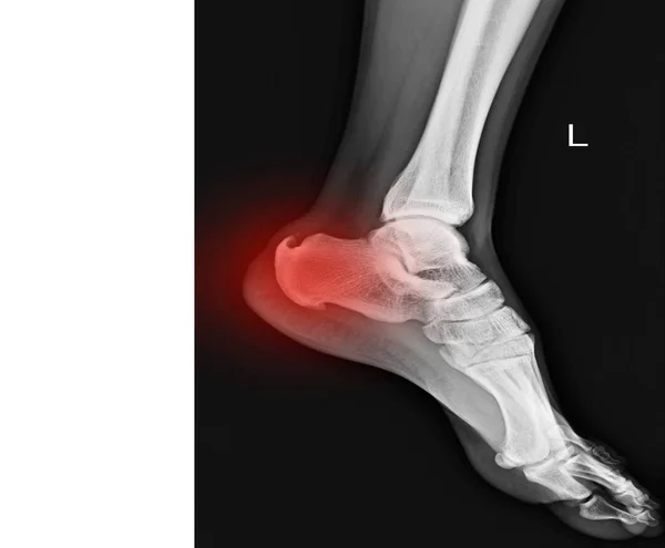 Ακτινογραφία Αριστερό Πόδι Εμφάνιση Calcaneal Παρακινήσει Κόκκινο Χρώμα Αντίγραφο Χώρου — Φωτογραφία Αρχείου