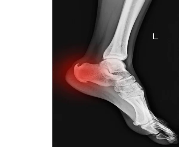 Linkervoet Weergegeven Calcaneal Ray Aansporen Rode Kleur Met Kopie Ruimte — Stockfoto