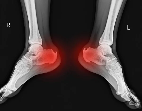 Рентгенівські Обидві Ноги Показують Яткову Шпору Червоному Кольорі — стокове фото
