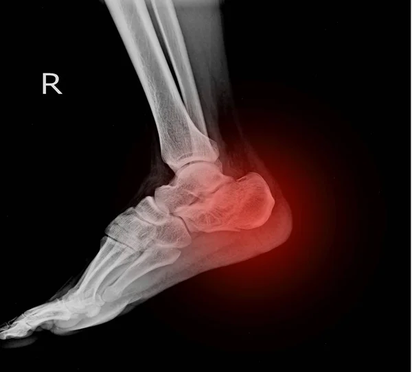 X-ray of the foot broken calcaneal/Heel  on red color.