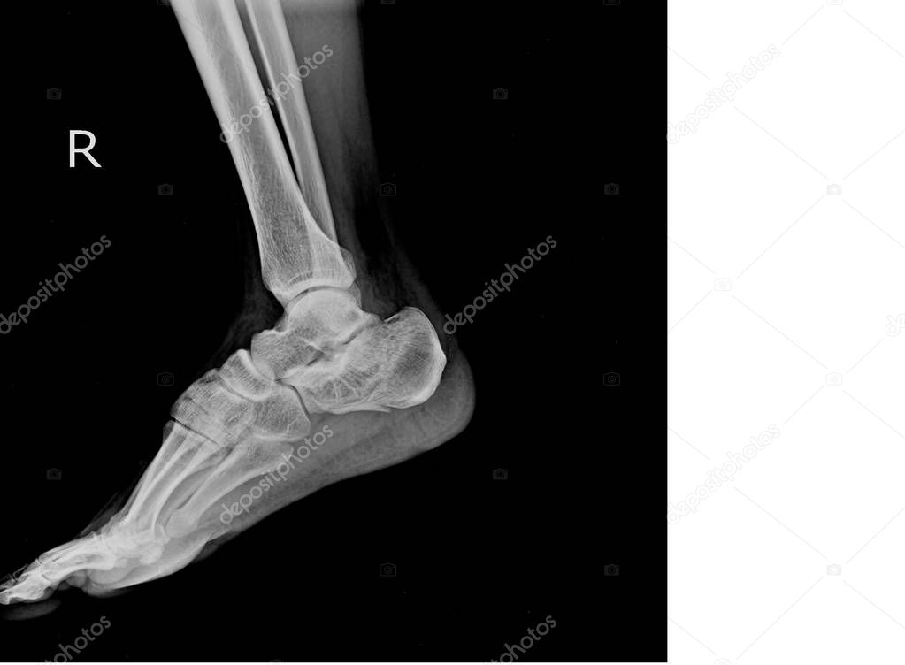 X-ray of the foot broken calcaneal/Heel with copy space.