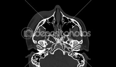 Yörüngenin hesaplanmış tomografisi (CT taraması), 26 yaşındaki bir erkek trafik kazası sağ ve orta yörünge duvarındaki kırık yerinden çıkmış..