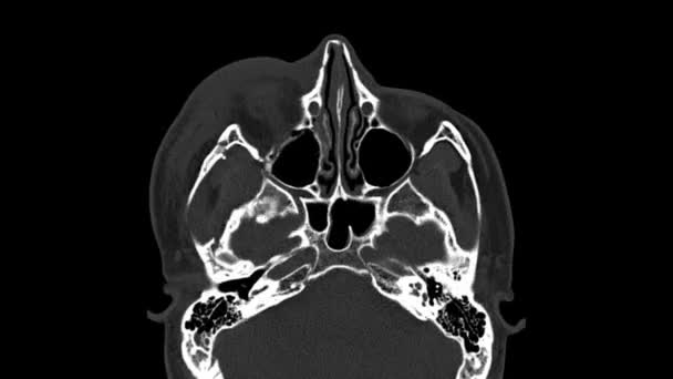 Computertomografie (CT-scan) van de baan, een mannelijk 26-jarig verkeersongeval Verbrijzelde breuk aan de laterale en mediale wand van de rechterbaan. — Stockvideo