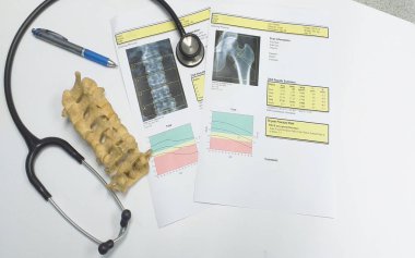 kemik yoğunluğu kalça ve lumbarvertebra sonuç osteoporoz