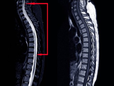 MRI OF THORACIC SPINE HISTORY: A 53-year-old woman, presented wi clipart