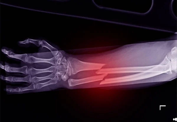 Fracture shaft of radius and ulnar bone — Stock Photo, Image