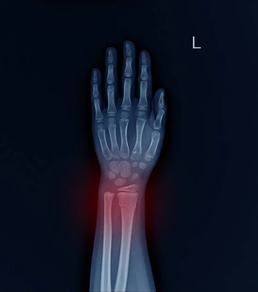 Left Wrist X-ray fracture raduis. — Stock Photo, Image