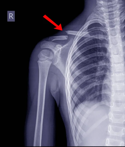 Rentgen hrudníku pravé klíční kosti. — Stock fotografie