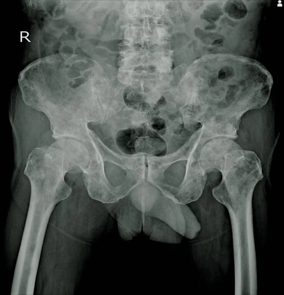 X-ray both Hip impression: Multiple bone metastasis.