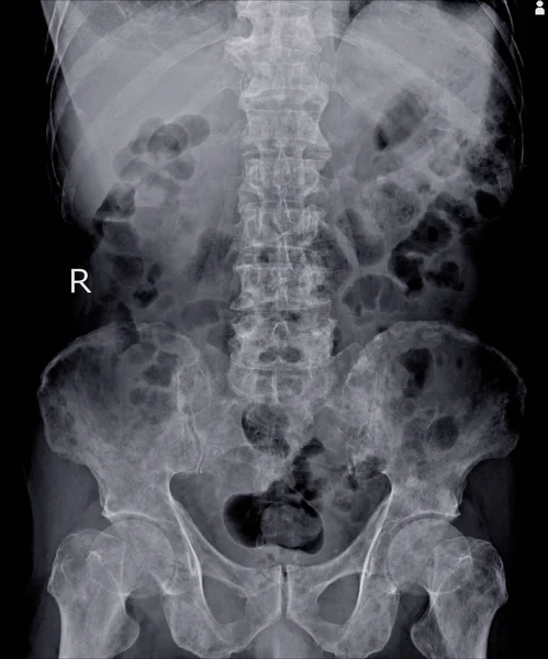 X-ray lędźwiowego kręgosłupa wrażenie: wiele przerzutów do kości. — Zdjęcie stockowe