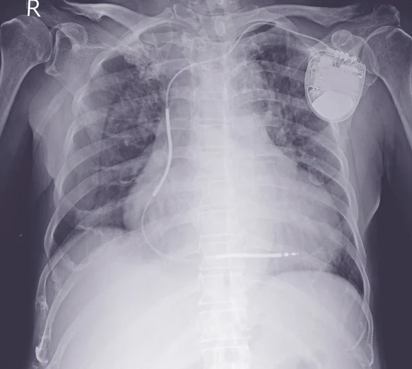 Chest x-ray evere cardiomegaly. Moderate pulmonary congestion.