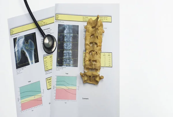 Densidade óssea da anca e da coluna lombar Resultado Osteoporose — Fotografia de Stock