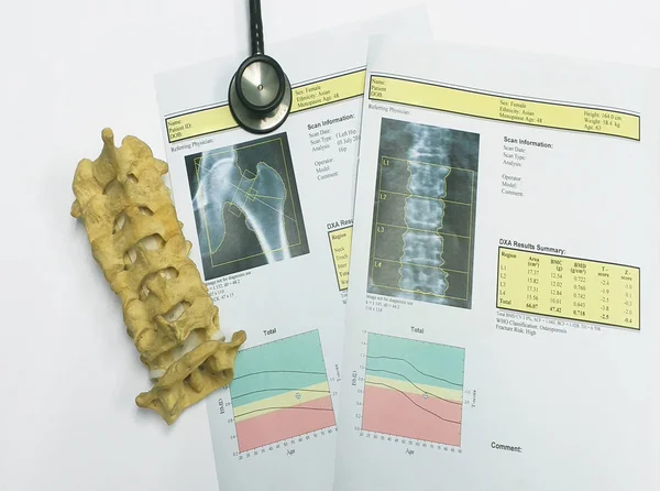 Densidad ósea cadera y columna lumbar Resultado Osteoporosis —  Fotos de Stock