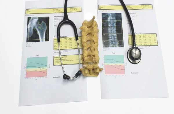 Botdichtheid heup en lumbarspine resultaat osteoporose — Stockfoto