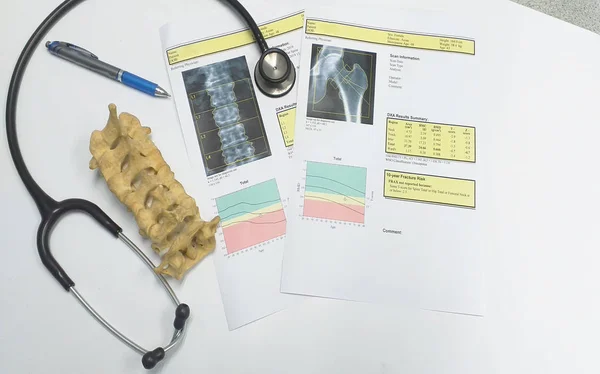 Densidade óssea da anca e da coluna lombar Resultado Osteoporose — Fotografia de Stock