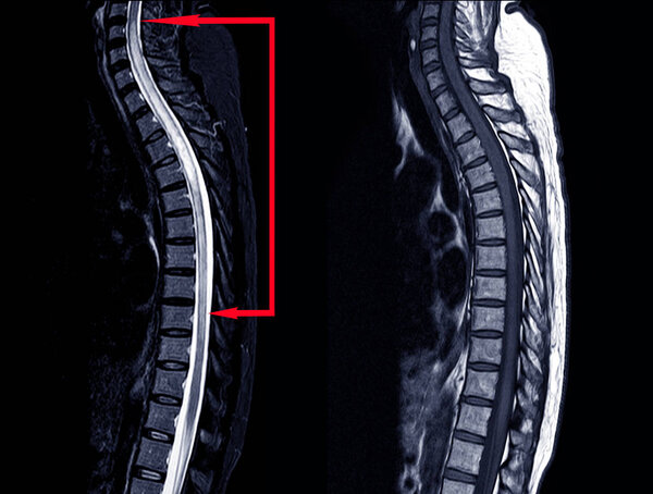 MRI OF THORACIC SPINE HISTORY: A 53-year-old woman, presented wi
