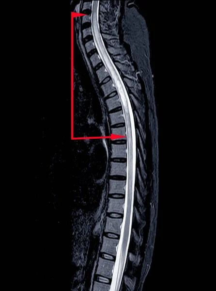 MRI OF THORACIC SPINE HISTORY: A 53-year-old woman, presented wi
