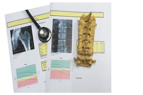 Densidade óssea da anca e da coluna lombar Resultado Osteoporose — Fotografia de Stock