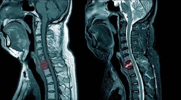 MRI of cervical spine compression fracture at C7. — Stock Photo, Image