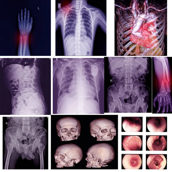 Gyűjtemény X-ray több része az ember ortopéd műtétek M — Stock Fotó