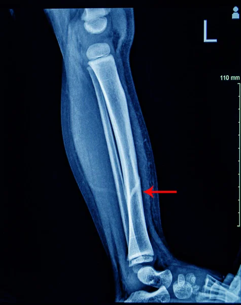 X-ray vänster ben AP lat fraktur Tibia. — Stockfoto