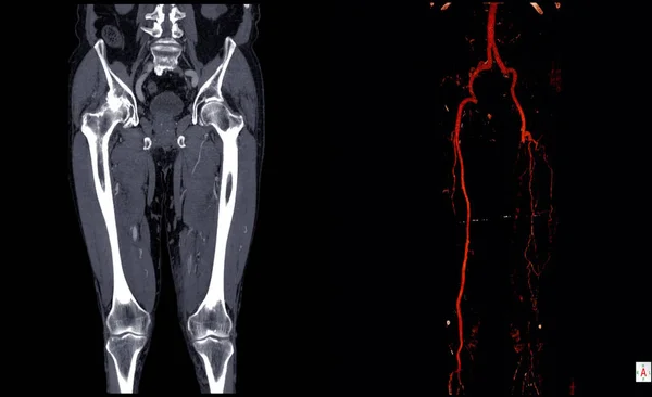 Alt ekstremitelerin bilgisayarlı tomografi anjiyografisi (Bt anjiyografi veya Cta).
