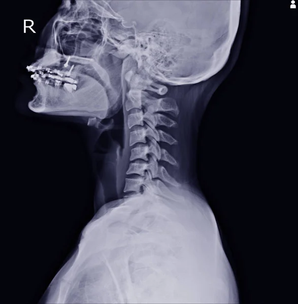 颈椎的X光片显示胸侧脊柱侧弯与颈椎侧弯从C4 5到C7 — 图库照片