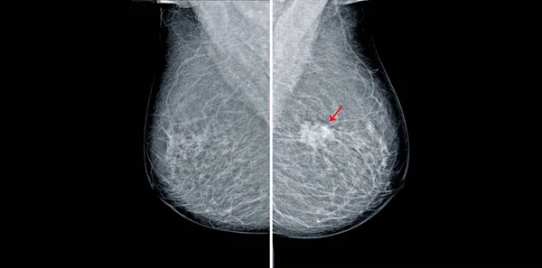 Mammogramm-Radiodarstellung zur Brustkrebsdiagnose — Stockfoto