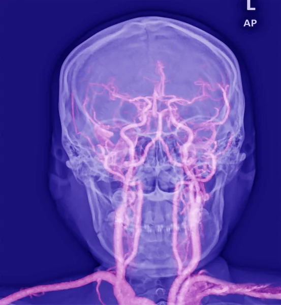 Magnetický rezonanční angiogram mozkové vaskulatury (tepny) — Stock fotografie