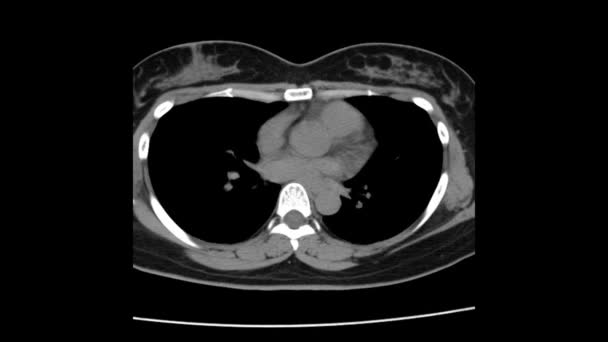 Pulmoner emboli ve akciğer hastalığı tanısı için Kontrastlı veya Kta pulmoner arterli Ct Göğüs. — Stok video