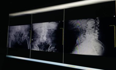 X-ray görüntü leğen kemiği ve kalça eklemi, dejeneratif değişim L4-5 omurga eğriliği.