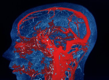 Mra and Mr.of Brain Finding: Kortekse çift taraflı bölgesel kaslar ve paryetal ve düşük hemisferler beyincik alt korteksi.