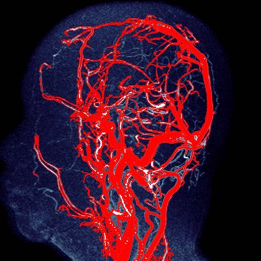 Beyin koronal 3d Sagittal Mip görünümü karotid arteri gösteriyor.