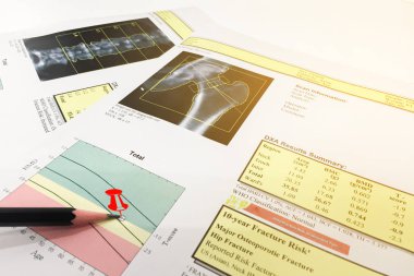 Kalça ve omurga mineral yoğunluğu (Bmd) Dexa densitometri kalça taraması
