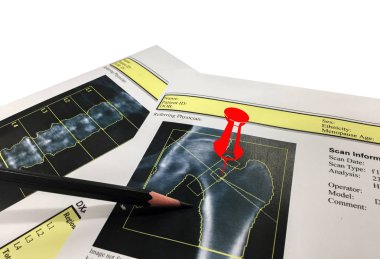 Kalça ve omurga mineral yoğunluğu (Bmd) Dexa densitometri kalça taraması