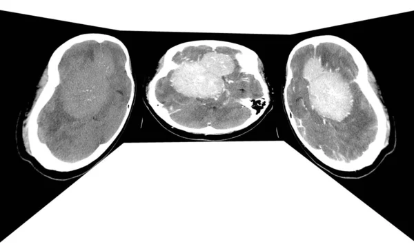 Αξονικές σαρώσεις Ct σάρωσης εγκεφάλου με πάχος φέτας 5 mm από την Om-line έως την κορυφή — Φωτογραφία Αρχείου