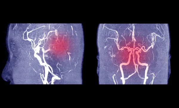 Beyin veya serebral arterin manyetik rezonans anjiyografisi . — Stok fotoğraf