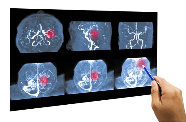 Angiografía por resonancia magnética de la arteria cerebral  . — Foto de Stock