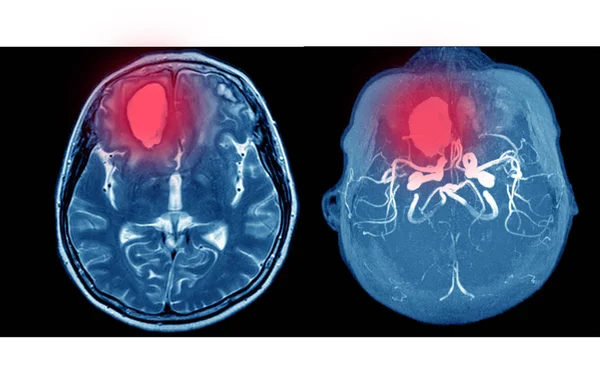 MRA Y MRV DEL CEREBRO Hemorragia intracraneal aguda múltiple . —  Fotos de Stock