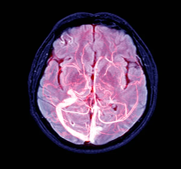 Venografia por ressonância magnética (MRV) Cérebro de veias na cabeça humana . — Fotografia de Stock