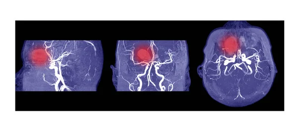 MRA Y MRV DEL CEREBRO Hemorragia intracraneal aguda múltiple —  Fotos de Stock