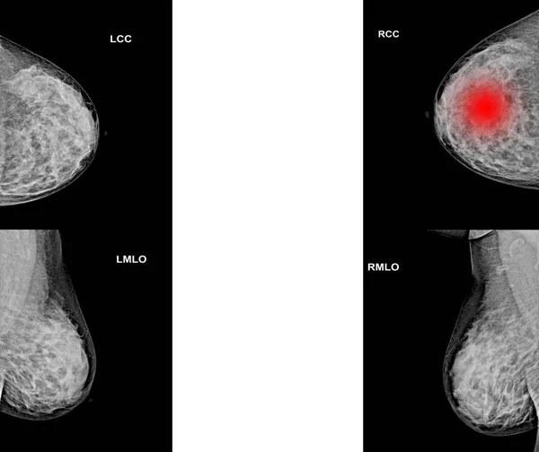 Both side collection of Mammogram radio imaging for breast cancer — Stock Photo, Image