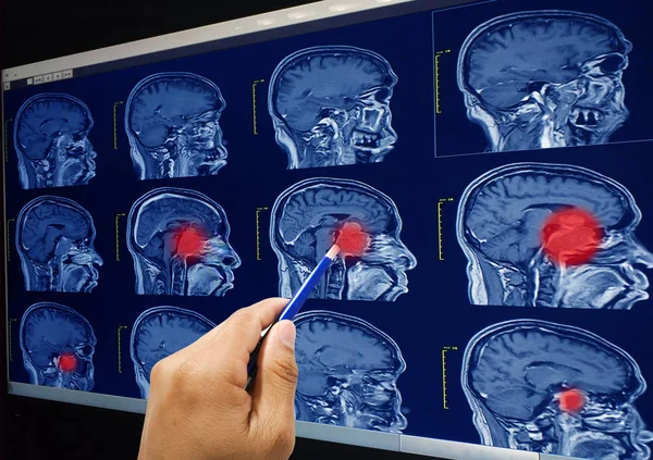 Magnetic resonance imaging (MRI) of the brain, brain tumor, brain abscess on red point.