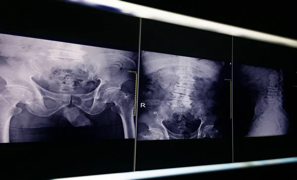 Imagem de raios-x osso pélvico e articulação do quadril, alteração degenerativa L4-5 escoliose lombar . — Fotografia de Stock