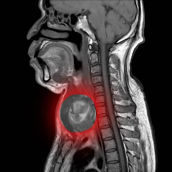 Магнітно-резонансна томографія (МРТ) шиї, сагітальний вид , — стокове фото